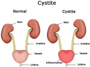 une cystite